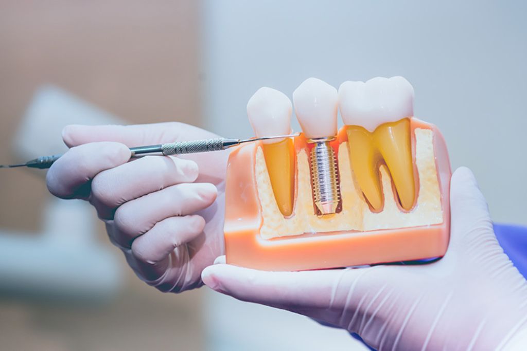 Implanty dentystyczne Torrevieja | Klinika stomatologiczna De la Torre