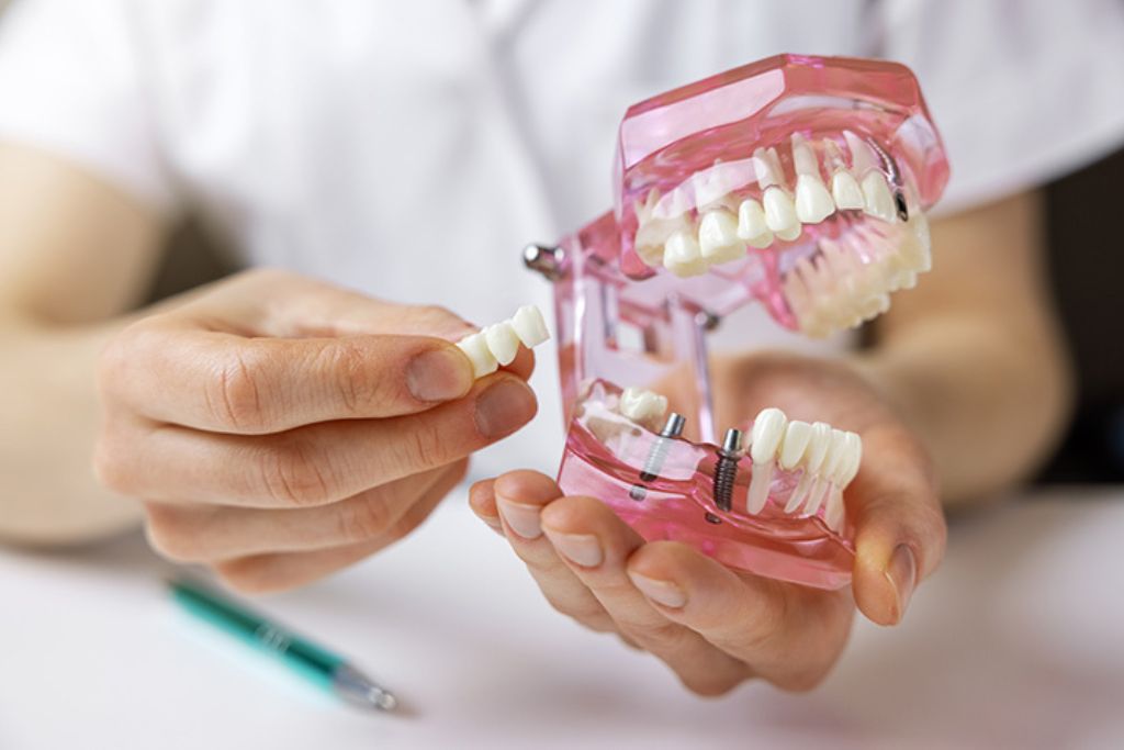 Зубні імплантати Торрев'єха | Стоматологічна клініка De la Torre
